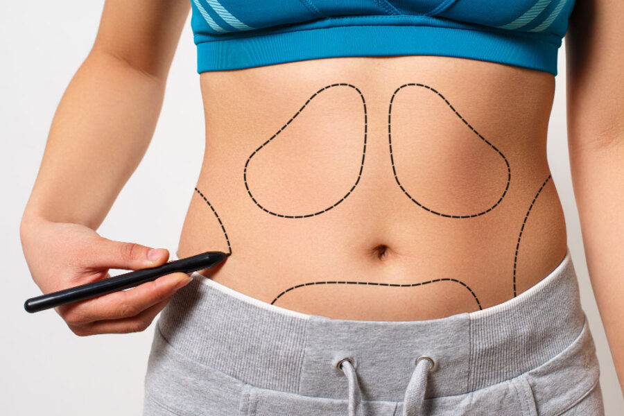 Tummy Tuck vs. Liposuction: Key Differences Explained